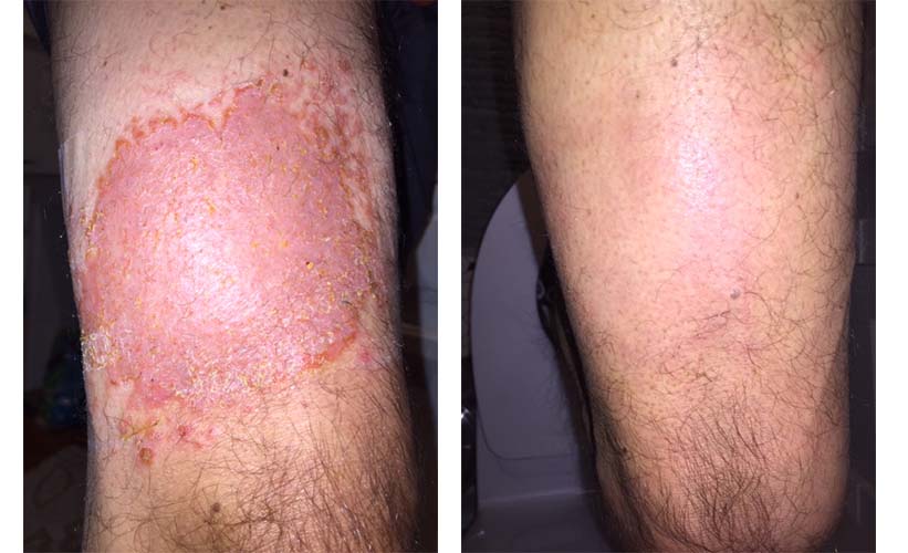 Jangles Infection Fungal infection - दाद (Daad) या खुजली (Khujli) – Nilkamal Ayurveda
