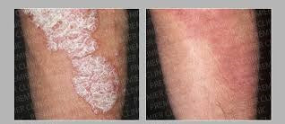 दाद, खाज, और खुजली